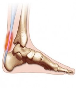 achilles-tendonitis (1)