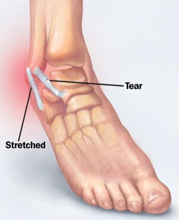 ankle-sprain